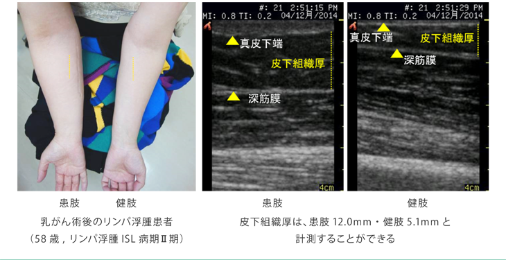 乳がん術後のリンパ浮腫患者（58歳,リンパ浮腫ISL病期Ⅱ期）,皮下組織厚は、患肢12.0mm・健肢5.1mmと計測することができる